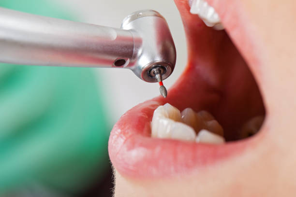 Best Emergency Dentist for Lost Fillings or Crowns in Mathews, VA